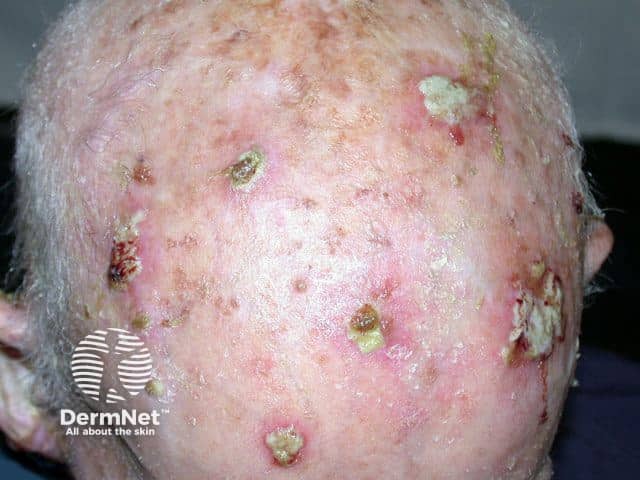 Множественный плоскоклеточный рак кожи волосистой части головы