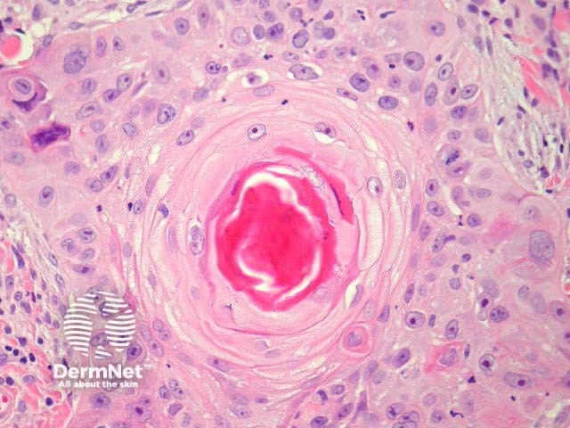 Рисунок 5. Умеренно дифференцированный плоскоклеточный рак (G2): очаговая кератинизация и умеренный полиморфизм