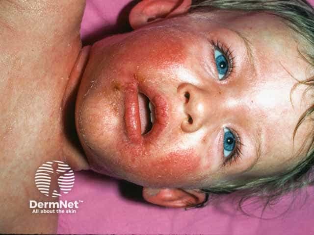 Эритема, шелушение и корки у грудного ребенка с синдромом стафилококковой ошпаренной кожи