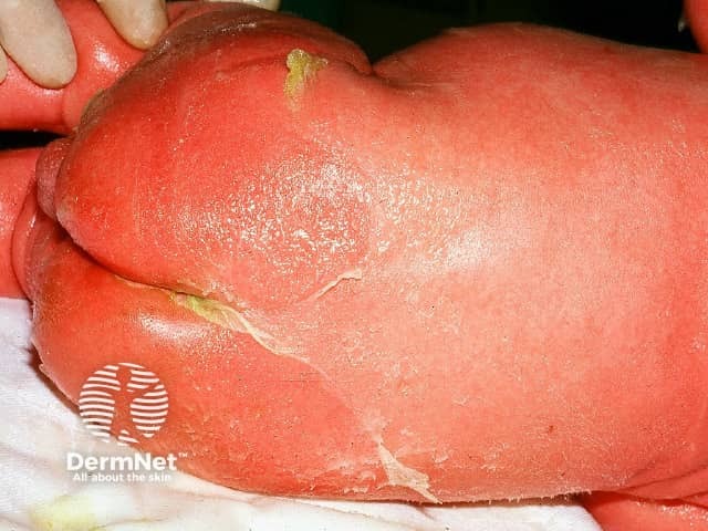 Синдром стафилококковой ошпаренной кожи