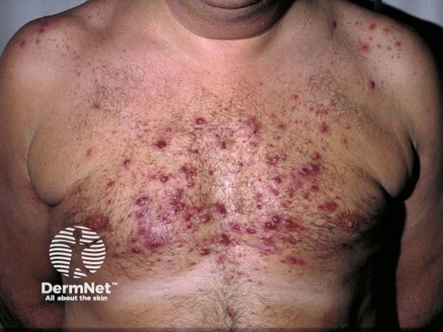 Стероид-индуцированные вульгарные угри (acne vulgaris)