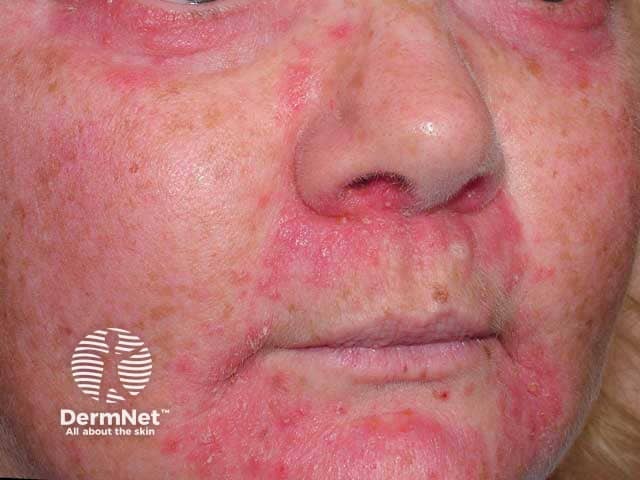 Стероид-индуцированная розацеа кожи лица и периоральный дерматит