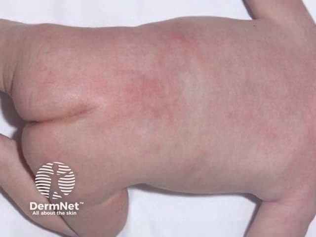 Плотные бляшки на спине новорожденного при подкожном жировом некрозе новорожденных