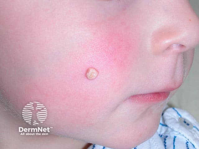Субэпидермальный кальцинированный узел на щеке — щеки и уши являются наиболее частой локализацией