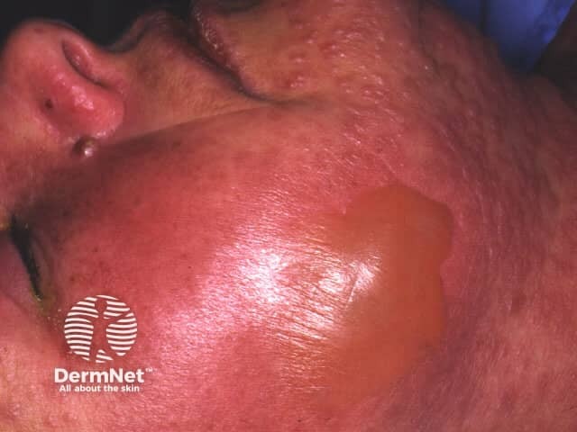 Токсический эпидермальный некролиз, индуцированный сульфаниламидами