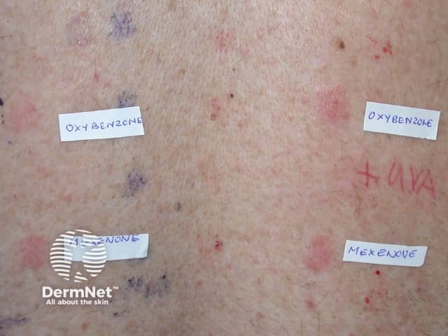 Аллергия на оксибензон и мексенон при патч-тестировании с фотоаггравацией (фотоиндуцированным усилением реакции)