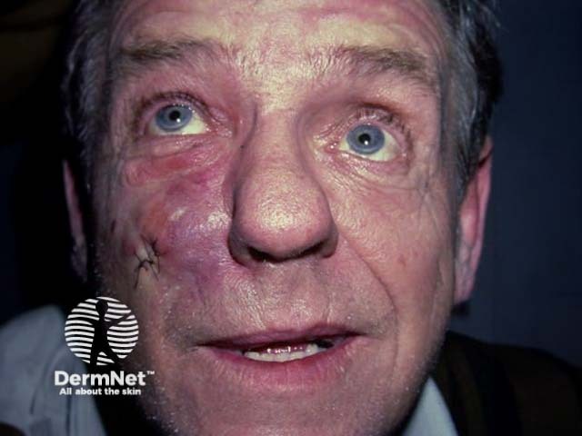 Третичный сифилис