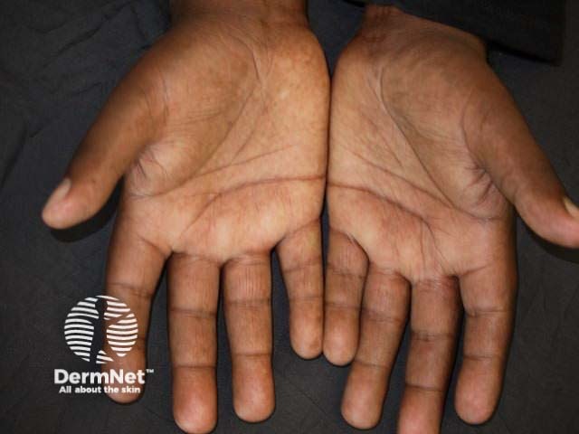 Отек кисти («отечные пальцы», puffy hands)