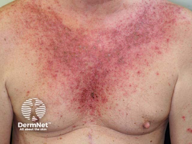 Экзематозный дерматит у мужчины, проходящего курс химиотерапии