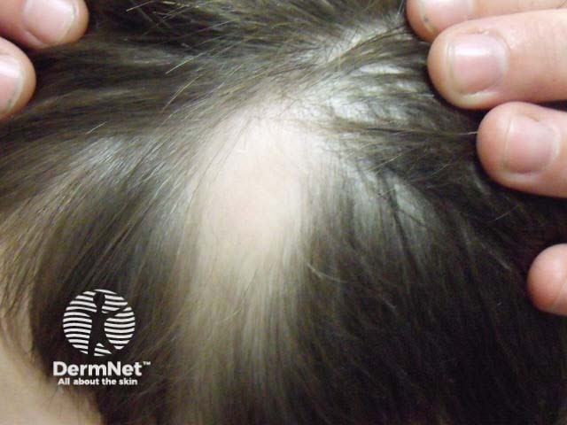 Височная треугольная алопеция: визуализация сохранного пушкового покрова в очаге