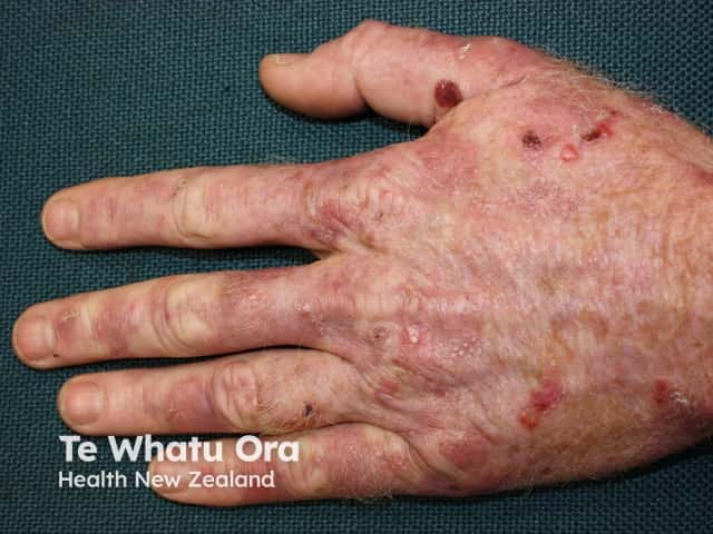 Поздняя кожная порфирия (Porphyria cutanea tarda)