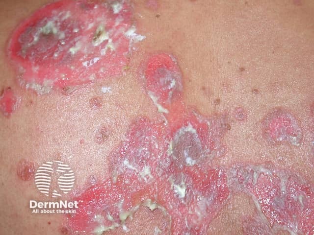 Вульгарная пузырчатка (Pemphigus vulgaris)