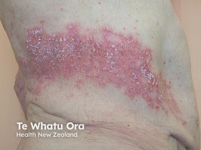 Опоясывающий лишай (herpes zoster)