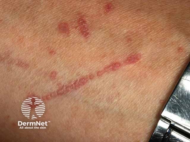 Линейные высыпания вследствие феномена Кёбнера при красном плоском лишае