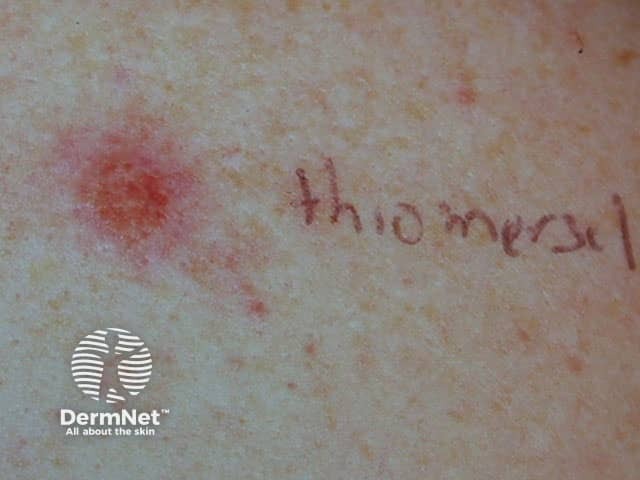 Положительная реакция аппликационного кожного теста (патч-теста) на тиомерсал
