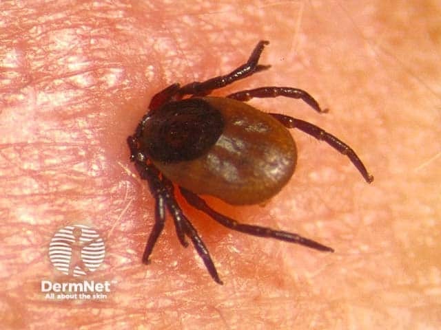 Воспалительная реакция в месте укуса клеща