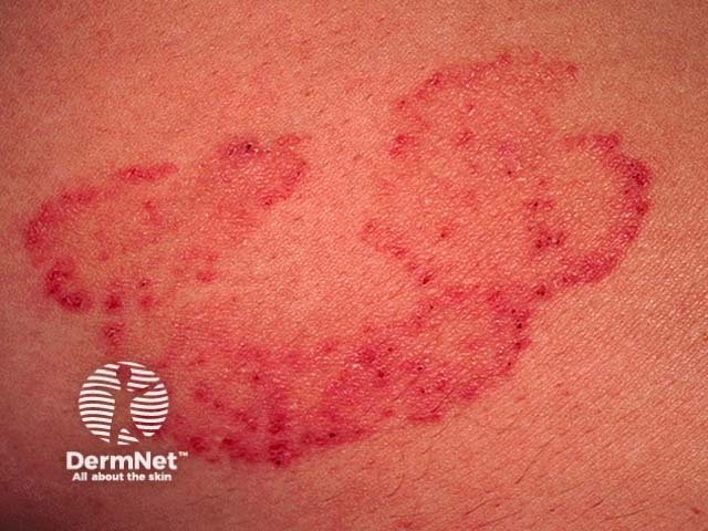 Микоз гладкой кожи (tinea corporis)