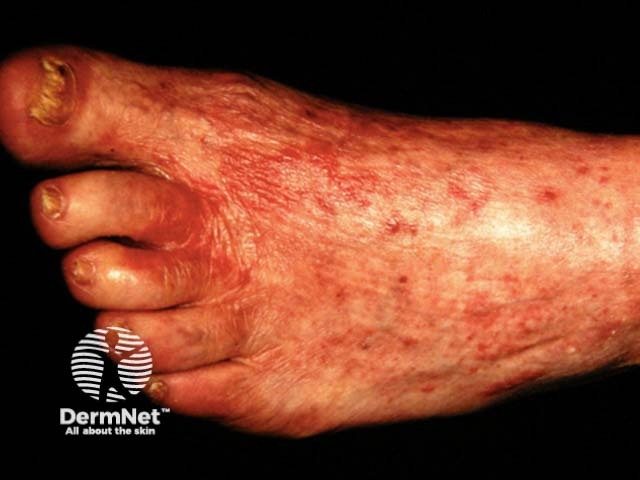 Tinea incognita (скрытый микоз) стопы