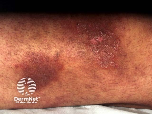 Tinea incognita (скрытый микоз) конечности