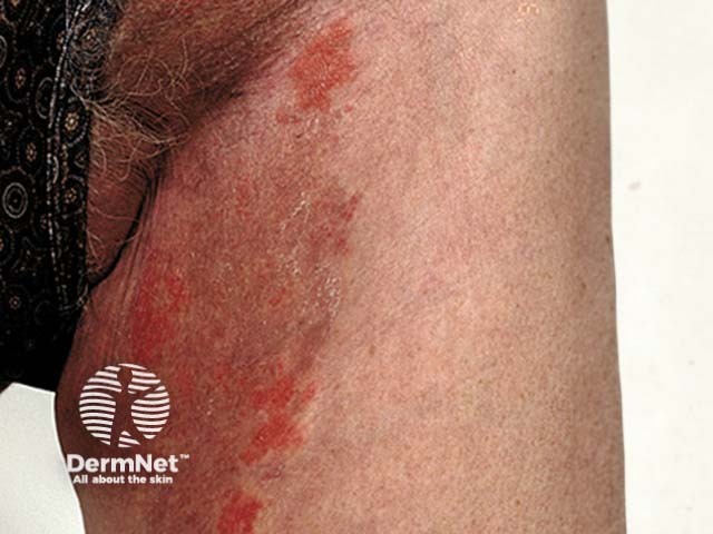Tinea incognita (скрытый микоз) паховой области