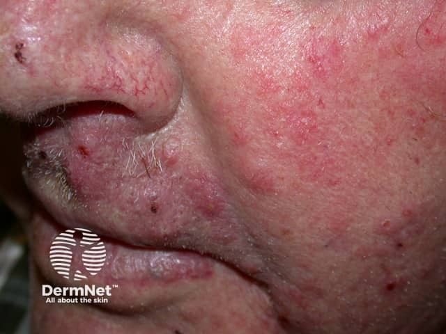 Tinea incognita (скрытый микоз) лица