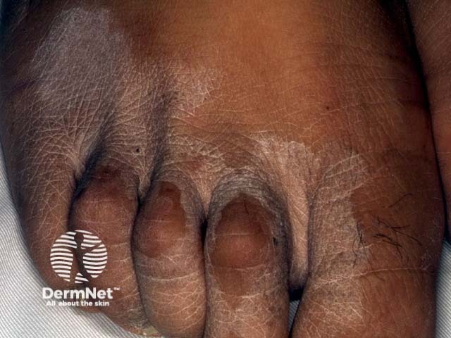 Tinea incognita (скрытый микоз) стопы