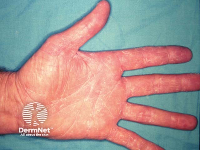 Микоз кистей (tinea manuum): гиперкератоз и шелушение в бороздах кожи кисти
