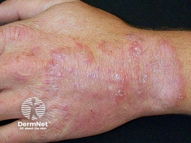 Микоз кистей (tinea manuum): сквамозные изменения ладонной поверхности