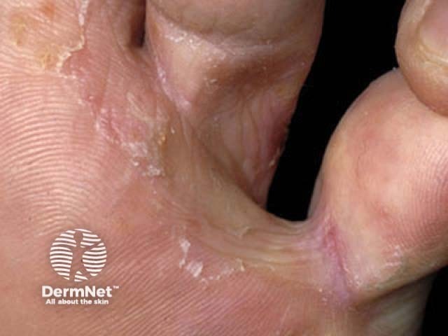 Микоз стоп (tinea pedis)