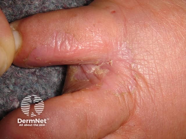 Микоз стоп (tinea pedis)
