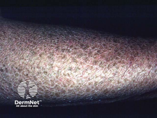 Х-сцепленный рецессивный ихтиоз