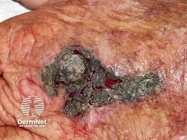 Химическая деструкция (коагуляция) нитратом серебра