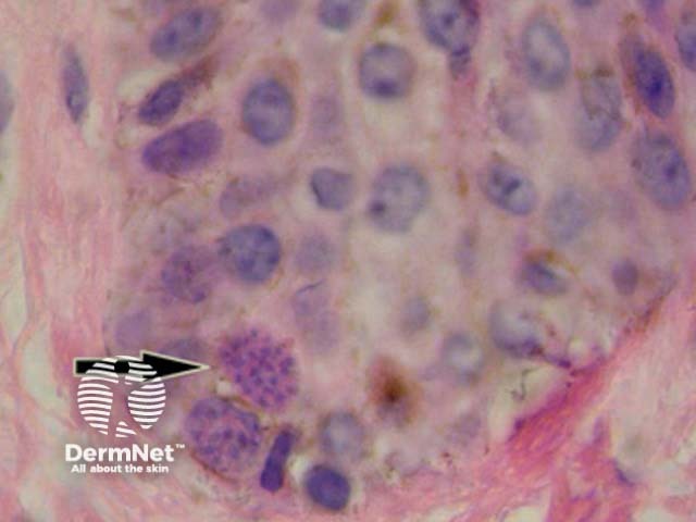 Рисунок 1. Брадизоиты и тахизоиты Toxoplasma gondii в кератиноцитах эпидермиса (указаны стрелкой)