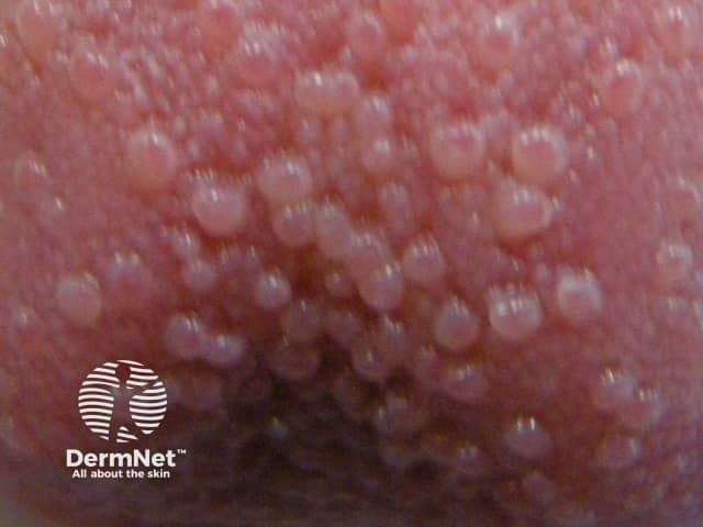 Транзиторный папиллит языка: болезненный воспалительный элемент