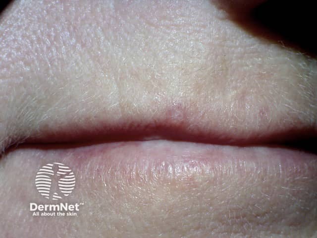 Трихилеммома: клиническая картина солитарного папулезного новообразования кожи