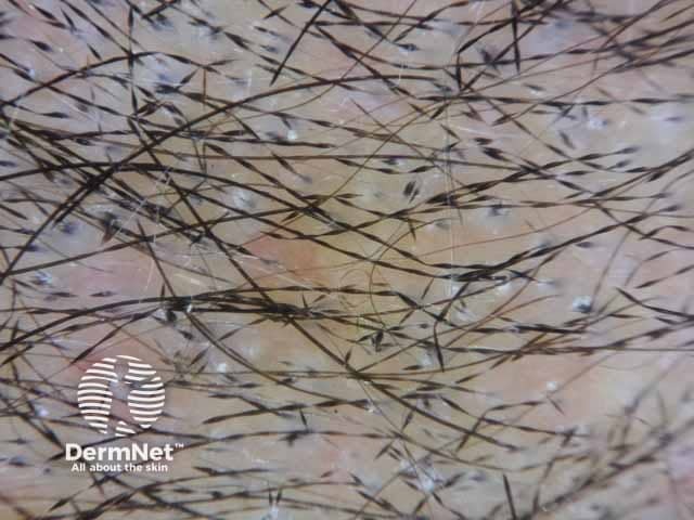Монилетрикс: периодические регулярные сужения и четкообразные утолщения вдоль стержня волоса