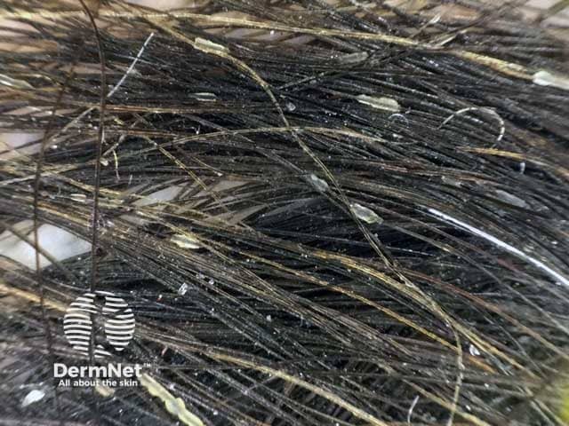Дерматоскопическая картина волосяных муфт (псевдомуфт), образованных слущенными гиперкератотическими и паракератотическими клетками внутреннего корневого влагалища вокруг стержня волоса