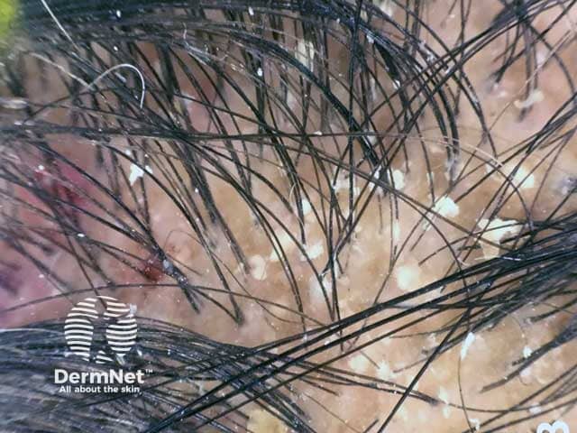 Дерматоскопическая картина: диффузные желтоватые жирные чешуйки у мужчины с себорейным дерматитом