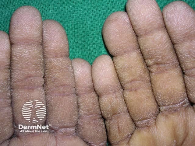 «Рубцовые ладони»: выраженное утолщение ладонной поверхности с подчеркнутым бархатистым дерматоглифическим рисунком