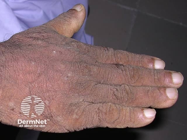 Чернеющий акантоз (acanthosis nigricans) кожных складок у пациента со злокачественным процессом