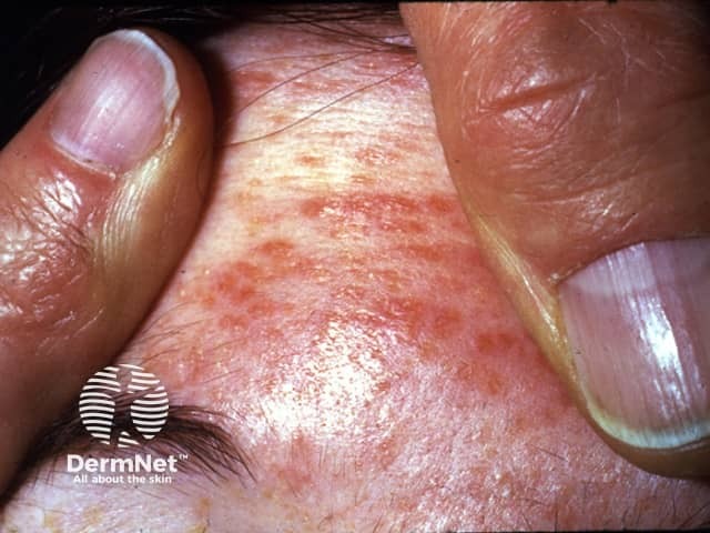 Туберкулез кожи: туберкулид — лишай золотушных (lichen scrofulosorum)