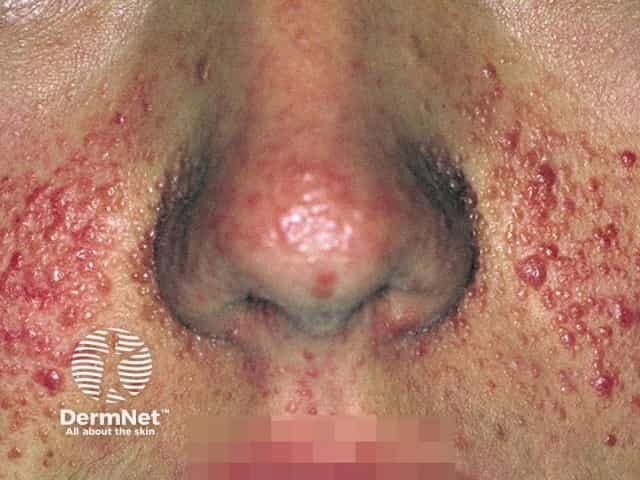 Ангиофибромы при туберозном склерозе