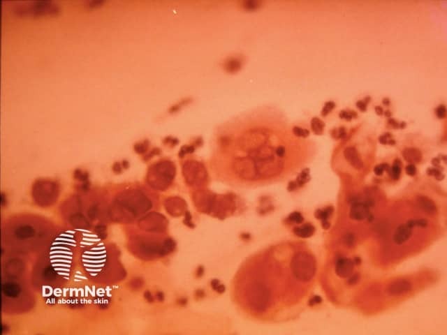 Мазок по Цанку при простом герпесе (Herpes simplex)