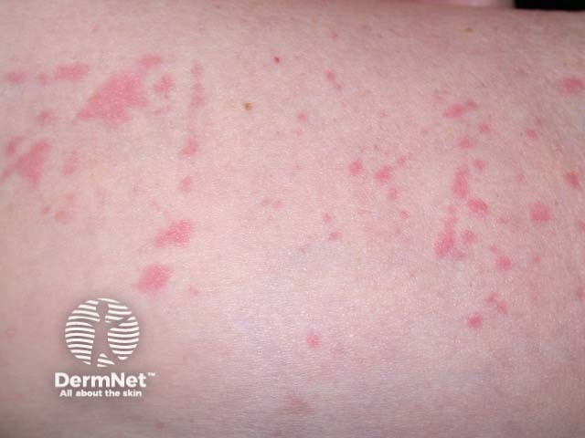 Уртикакарный васкулит: поражение нижних конечностей
