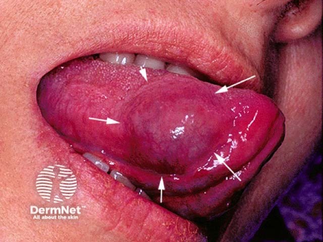 Сосудистая мальформация