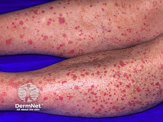Кожный васкулит с геморрагическими элементами
