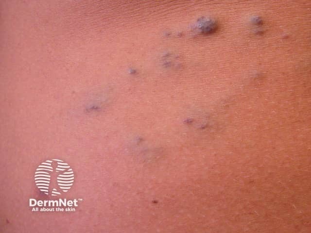 Синдром синего резинового пузырчатого невуса (синдром Бина): множественные кожные венозные дисплазии