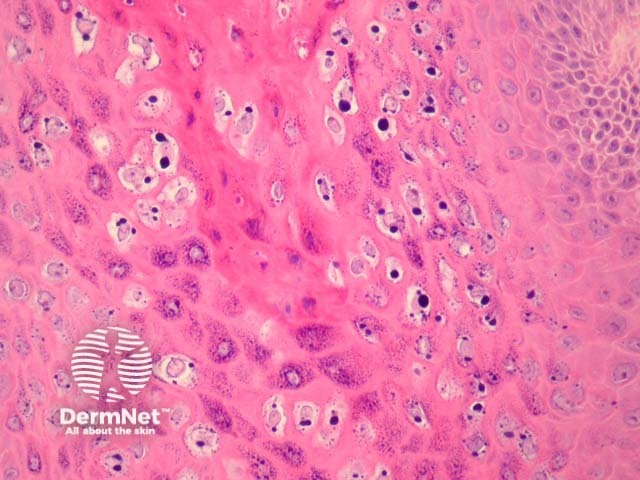 Рисунок 3. Койлоциты с перинуклеарным гало и базофильной зернистостью в верхних слоях эпидермиса.