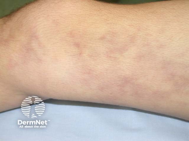 Сетчатое ливедо (livedo reticularis) при узелковом полиартериите