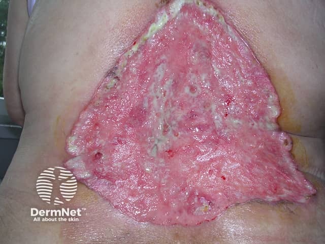 Распространенный базальноклеточный рак кожи